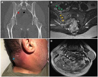 Community-acquired methicillin-resistant Staphylococcus aureus invasive infections: a case series from Central-South Chile